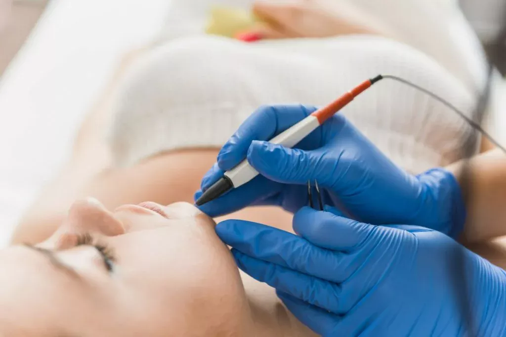 Elektroepiliatsiia oblychchia skilky protsedur potribno